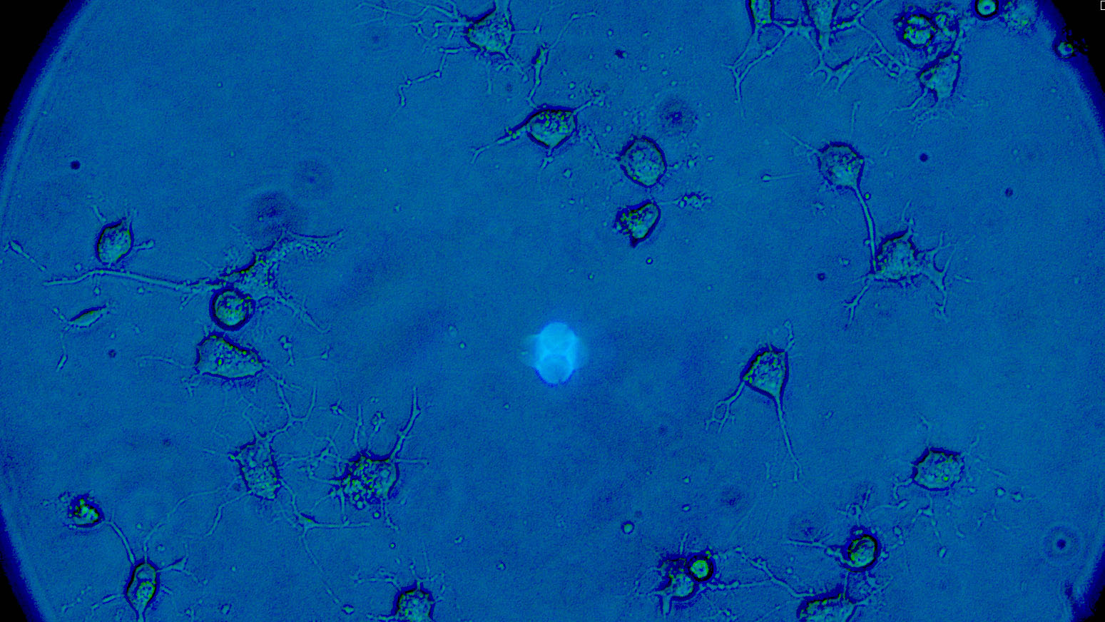 http://Image%20of%20ovarian%20cancer%20cells%20and%20their%20invadopodia%20from%20a%20microscope